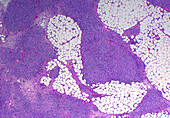 Granulomas, light micrograph