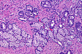 Prostate glands mucinous metaplasia, light micrograph