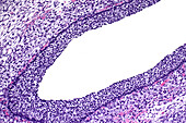 Benign ovarian cyst, light micrograph
