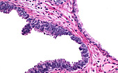 Prostate intraepithelial neoplasia, light micrograph