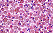 Macrophage cells ingesting hemosiderin, light micrograph