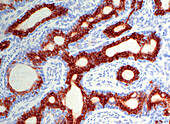 Basal cell adenoma immunostain, light micrograph