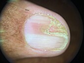 Darier's disease, dermoscopy