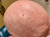 Basal cell carcinoma