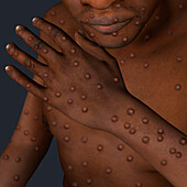 Monkeypox infection, illustration