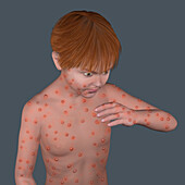 Monkeypox infection, illustration