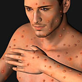 Monkeypox infection, illustration