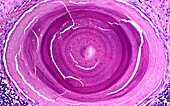 Prostate corpus amylaceous, light micrograph