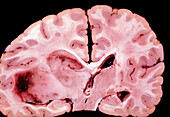 Human brain astrocytoma