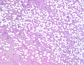 Well-differentiated liposarcoma, light micrograph