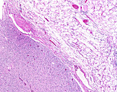 Dedifferentiated liposarcoma, light micrograph