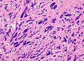 Undifferentiated pleomorphic sarcoma, light micrograph