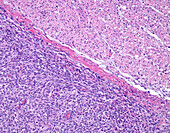 Malignant peripheral nerve sheath tumour, light micrograph