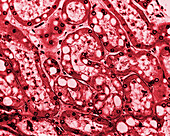 Hypokalemic nephropathy, light micrograph