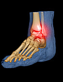 Ankle pain, conceptual image