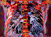 Healthy lungs, CT scan