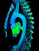 Aortic arch, CT scan