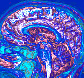 Healthy brain, CT scan