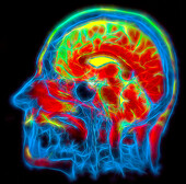 Healthy head and brain, MRI scan