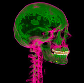 Head and neck bones, CT scan