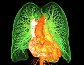 Healthy heart and lungs, CT scan