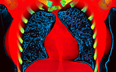 Healthy lungs, CT scan