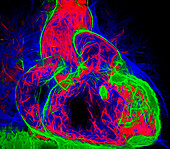 Healthy heart, CT scan