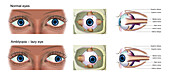 Normal eye and amblyopia, illustration