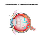Retinal detachment, illustration