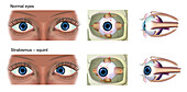 Normal eye and strabismus, illustration