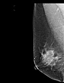 Normal mammogram