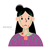 Swollen lymph gland, conceptual illustration