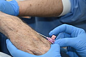 Surgeon inserting a cannula tube
