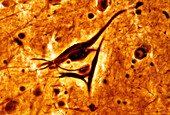 Neurofibrillary tangles in pyramidal neuron, light micrograph