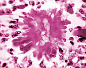 Candida albicans fungus in liver tissue, light micrograph