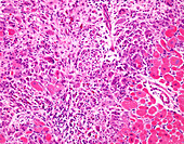 Giant cell myocarditis, light micrograph