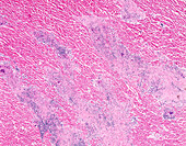 Sarcoidosis, light micrograph