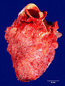 Fibrinous pericarditis