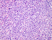 Diffuse large B cell lymphoma, light micrograph