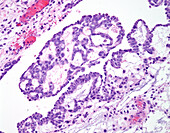 Pericardial mesothelioma, light micrograph