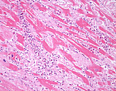 Cardiac amyloidosis, light micrograph