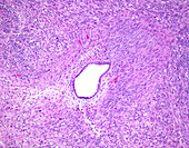 Adenosarcoma of uterus, light micrograph