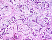 Adenosarcoma of uterus, light micrograph