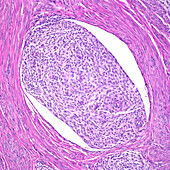 Endometrial stromal sarcoma, light micrograph