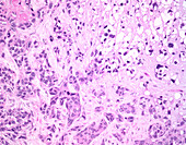 Epithelioid trophoblastic tumour, light micrograph