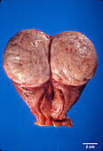 Uterine leiomyoma