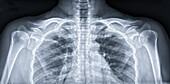 Shoulder joints, X-ray
