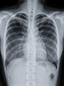 Healthy chest, X-ray