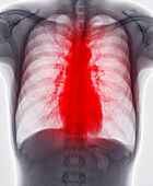 Heart disease, conceptual X-ray