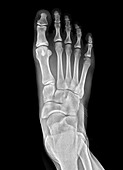 Healthy foot, X-ray
